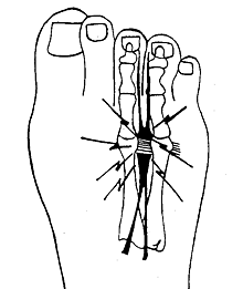 Neuroma